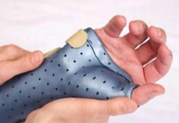 A hand supported by a custom wrist and thumb splint